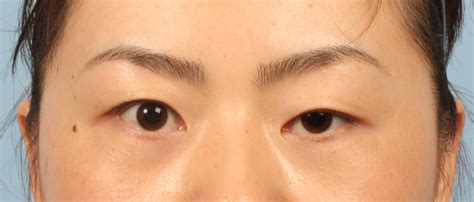 Wong Chin Ho W Aesthetics Plastic Surgery Corrective Eyelid Surgery