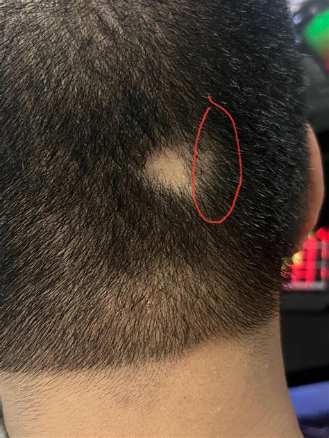 21m Random Bald Spot Appeared Back Of My Head 2 3 Months Ago And It Has Not Grown Back Is It