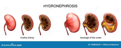 Blockage Of The Ureter Hydronephrosis Stock Vector Illustration Of