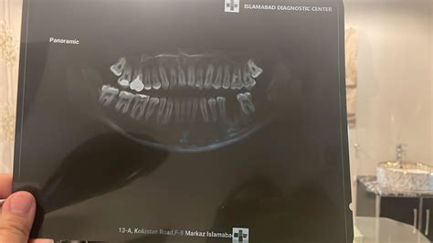 My dental X-ray before implant procedure : r/notinteresting