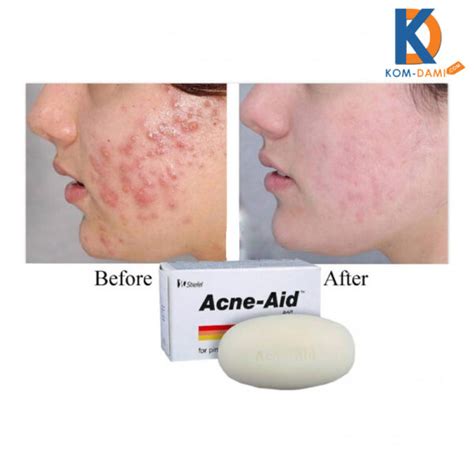 Stiefel Acne Aid Bar Pimple Prone And Oily Skin Acne Aid Soap 100g Kom Dami