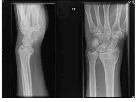 Ulnar Styloid Avulsion Fracture