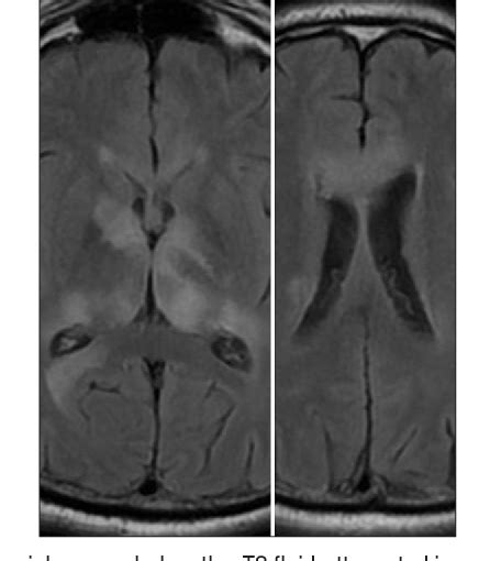 Figure From Wernicke Encephalopathy With Atypical Findings On