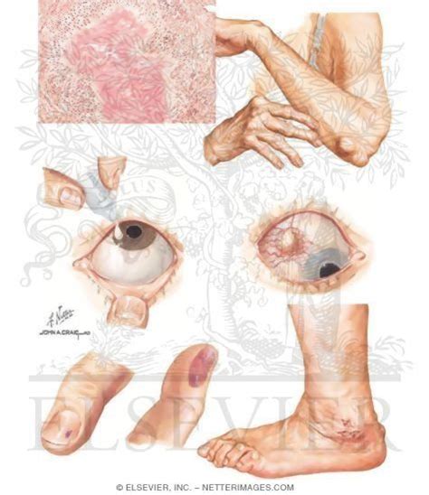 Extraarticular Manifestations Of Rheumatoid Arthritis Ra Arthritis