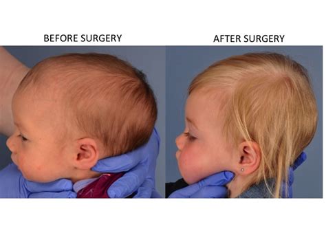 Minimally Invasive Endoscopic Sagittal Strip Craniectomy Before And