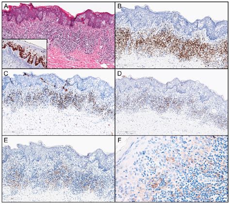 Immune Infiltrate Associated With Extramammary Paget Disease Empd