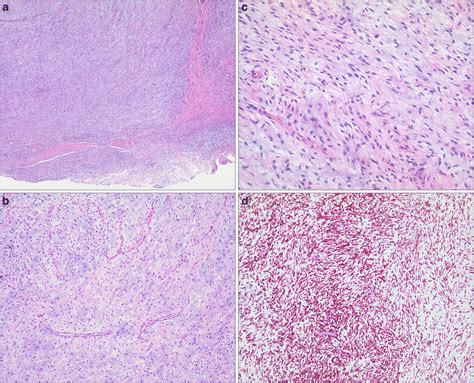 A Proliferation Of Bland Spindled Cells Set In A Variable Myxoid And