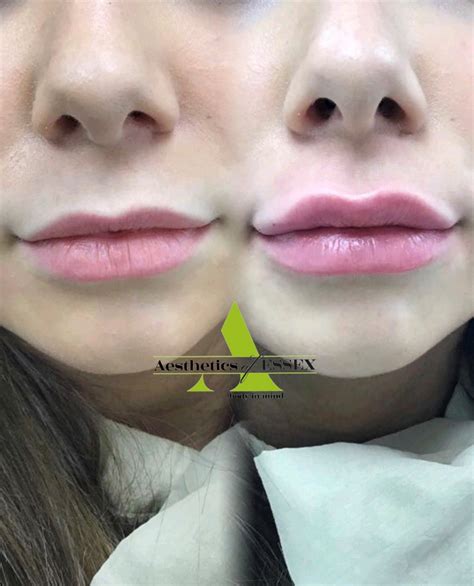 Lip Fillers In Essex Aesthetics Of Essex