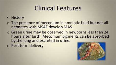 Meconium stained amniotic fluid aspiration syndrome