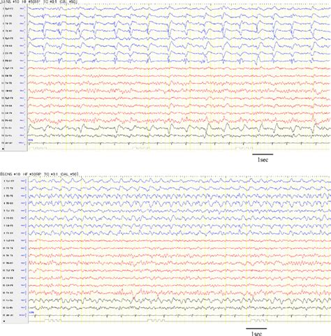 Preoperative Eeg On Admission A Left Lateralized Periodic Discharges