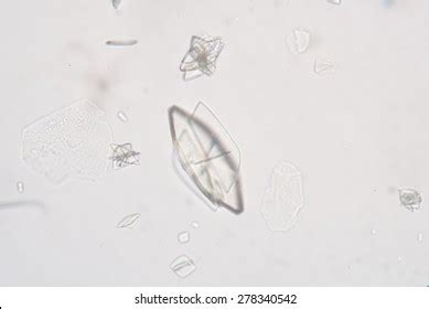 Uric Acid Crystals Urine Analysis Stock Photo Shutterstock