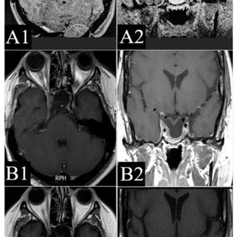 Serial Contrast Enhanced Mri Brain Images Including Gkrs Planning In