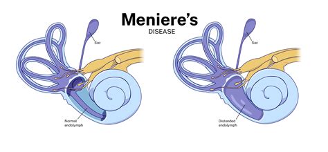 Menieres Disease