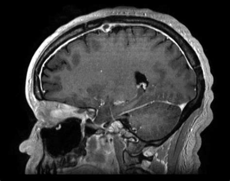 MRI brain: post-contrast sagittal sequence showing pachymeningeal ...