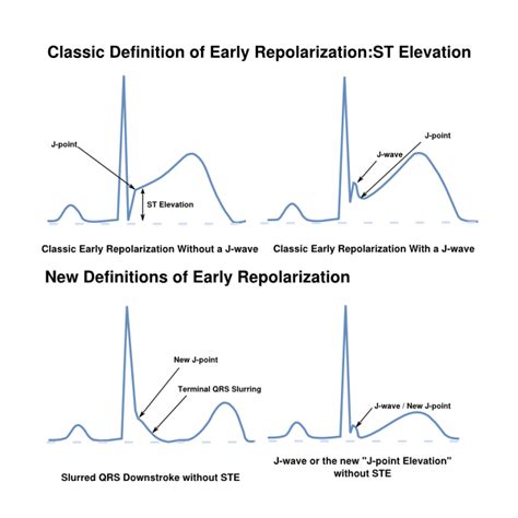 St Morphology Ecgpedia