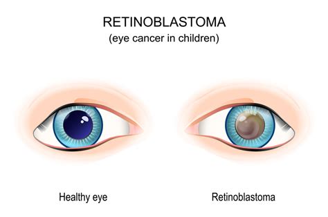 Can Retinoblastoma Be Fatal Raynes Lawn