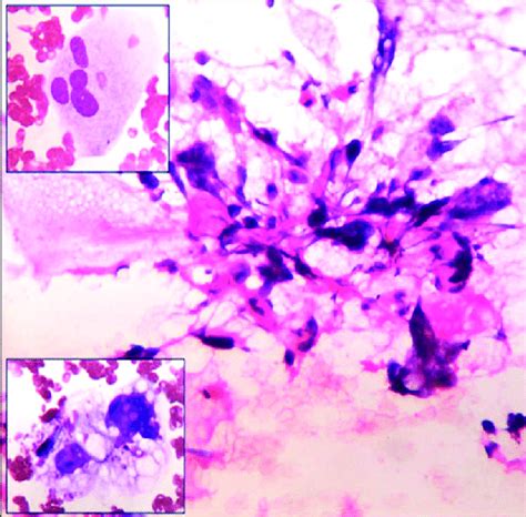 Cytology Smears Showing Clusters Of Pleomorphic Spindle To Round Cells Download Scientific