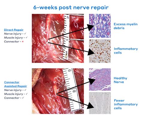 for small gap, digital nerve repair,how often is primary repair really ...