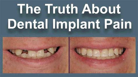 Is Dental Implant Painful Dental News Network