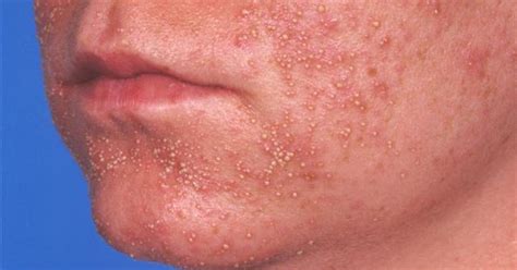 What Is Folliculitis Teroes