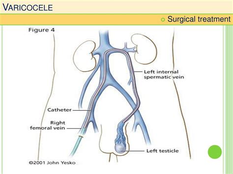 Ppt The Varicoceles Impact Over The Masculine Fertility Powerpoint