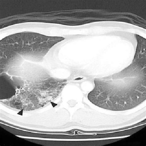 Pdf Adult Onset Congenital Cystic Adenomatoid Malformation In