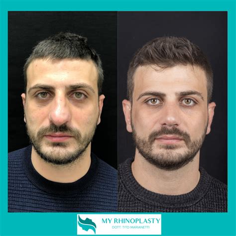 Naso Rifatto Prima E Dopo 6 Casi Di Rinoplastica My Rhinoplasty