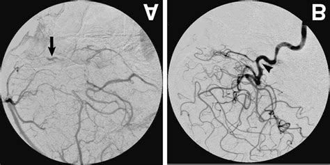 Case Left Internal Carotid Angiograms Lateral View Showing A