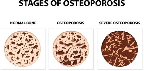 Bone Density And Weight Bearing Exercise The Orthopedic And Sports