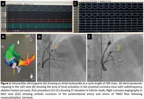 inferior st elevation myocardial infarction  rare complication
