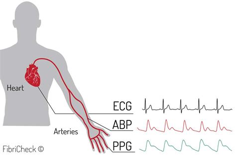 Fibricheck Beat To Beat Accuracy Compared With Wearable Ecg In Broad