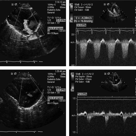 Echocardiography Revealing A Tricuspid Regurgitation Jet Indicative Of