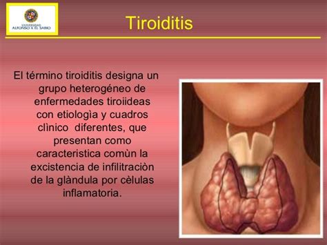 Tiroiditis