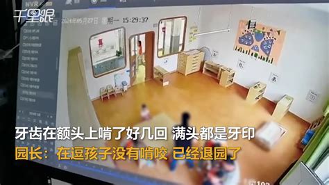 【山西】网友爆料孩子在幼儿园不喝水额头被园长啃出牙印。园长：在逗孩子没有啃咬，已经退园了