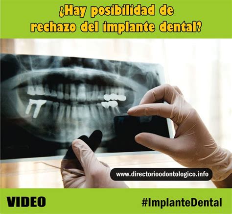 Infopaciente Hay Posibilidad De Rechazo Del Implante Dental