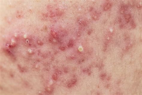 Acne O que é Causas e Tratamento Dicas de Musculação