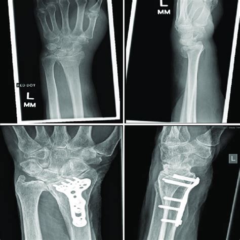 Anteroposterior And Lateral Radiographs Pre Operative And Following