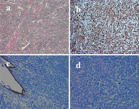 Histological Features Of A High Grade Endometrial Stromal Sarcoma A