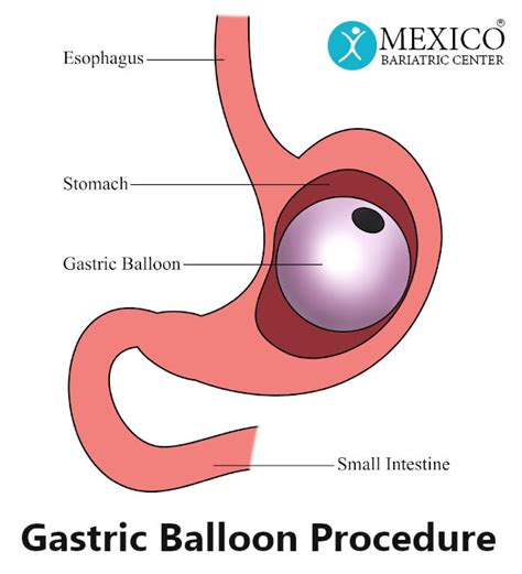 Gastric Balloon Cost Mexico Bariatric Center