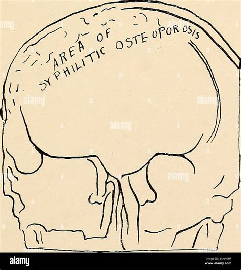 Roentgen Diagnosis Of Diseases Of The Head Fig 19 A Posteroanterior