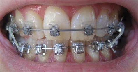 Class Ii Elastics In Orthodontics Gisele Garris