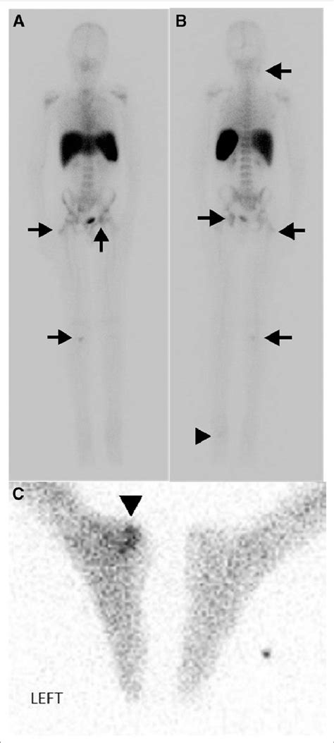 Anterior A And Posterior B Whole Body Planar Images And Spot Image