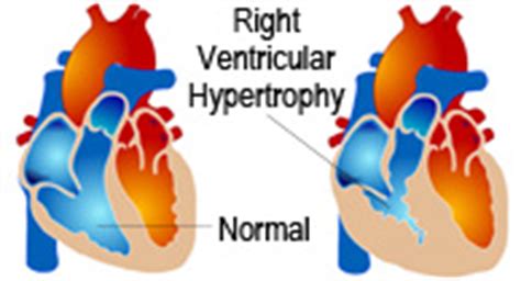 Cor Pulmonale: Causes, Symptoms, and Diagnosis