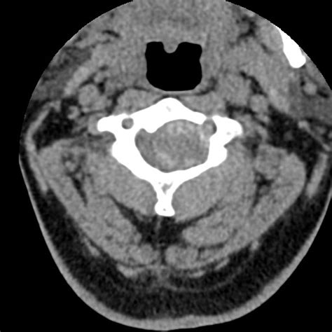 Cervical Spinal Neurofibroma In A Patient With Nf Radiopaedia