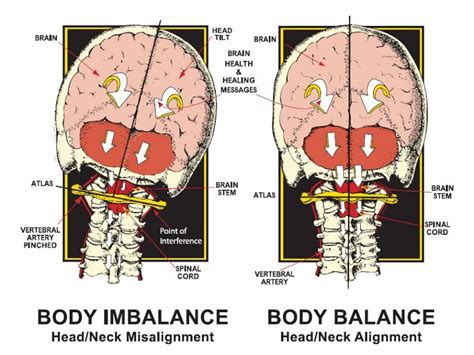 Is It Really Cci Craniocervical Instability Fund