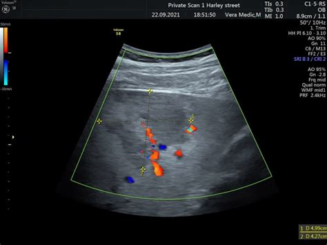 Liver Scan Private Ultrasound Scans London