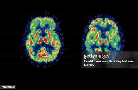 Depression Brain Scan Photos Et Images De Collection Getty Images