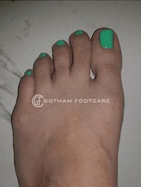 Bunion Surgery NYC Bunion Surgery Manhattan