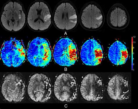 Comparison Of Arterial Spin Labeling And Bolus Perfusion Weighted