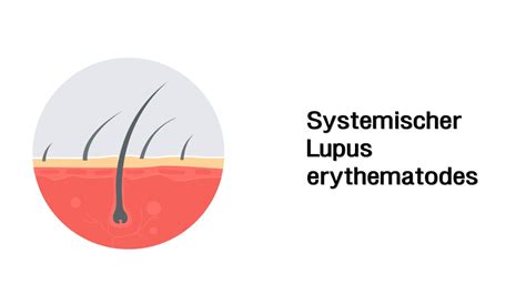 Systemischer Lupus Erythematodes Erkrankungen Der Haut Mit